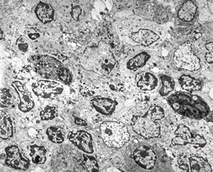 celiakia- infiltration in lamina propria celiakia- infiltration in lamina propria